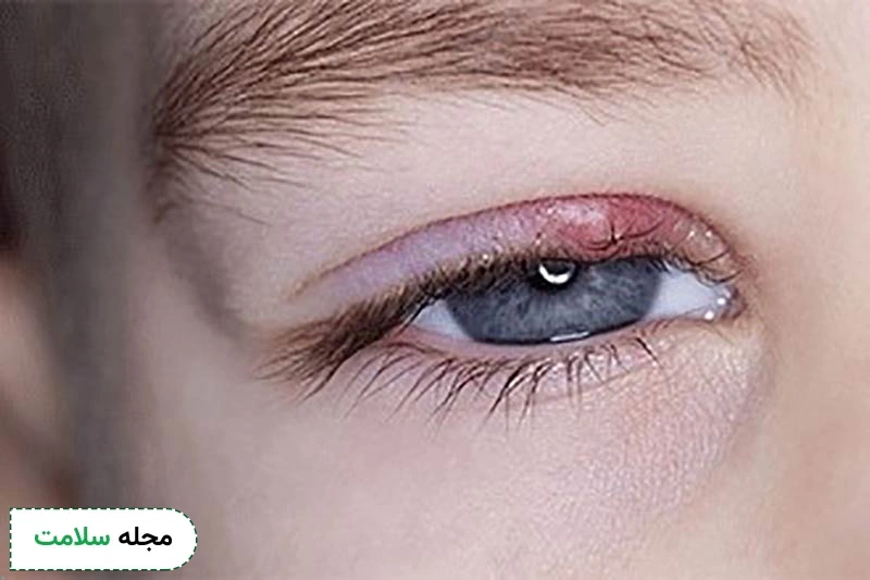 علت گل مژه چیست؟
