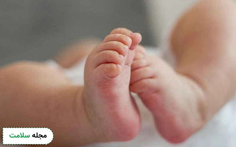 بهترین سن برای درمان پای پرانتزی چیست؟