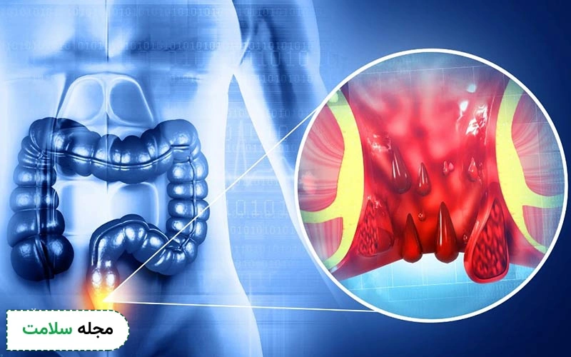 بواسیر داخلی چیست؟
