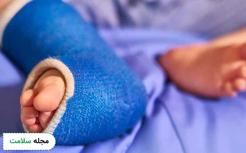 بررسی انواع روش های درمان پای پرانتزی