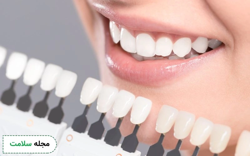 آیا میشود رنگ روکش دندان را تغییر داد؟
