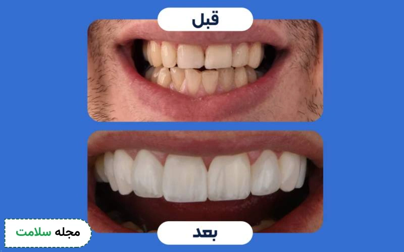 عکس قبل و بعد کامپوزیت دندان بعد تغییر رنگ شدید چگونه است؟
