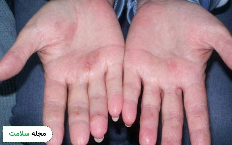 عکس زخم دیابتی انگشت دست