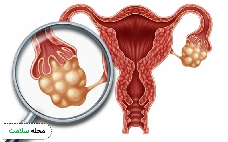 علت تخمدان پلی کیستیک در دختران جوان چیست؟