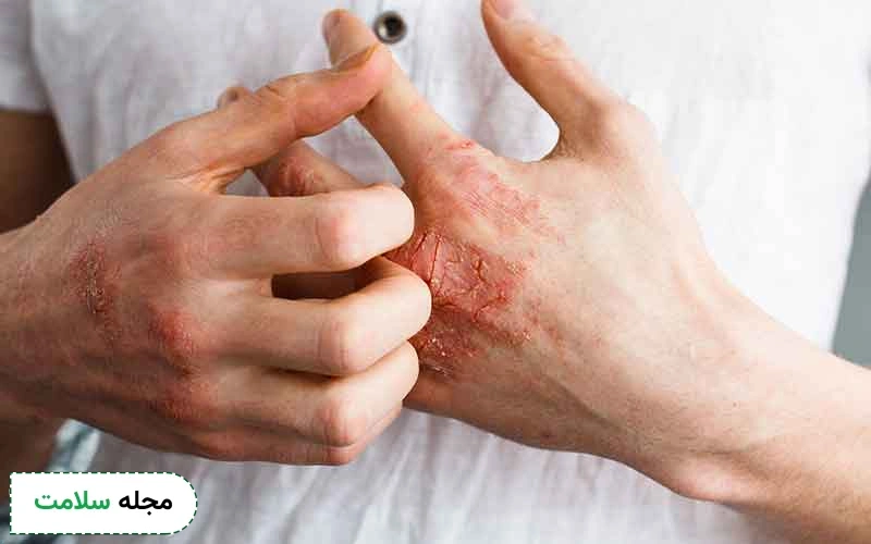فرق اگزما و قارچ پوستی در چیست؟