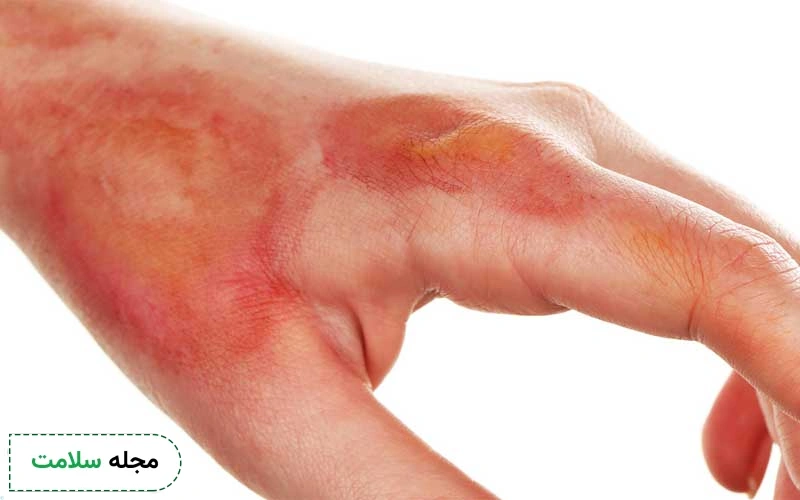زخم دست دیابتی تا چه اندازه خطرناک است؟