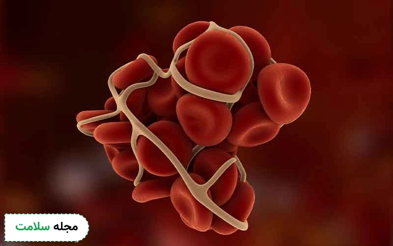 راه‌ های درمان پوسیدگی دندان در بیماران هموفیلی چگونه است؟