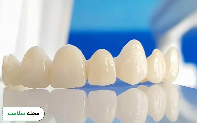 روکش دندان سرامیکی چه موادی دارد؟