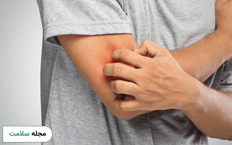 عوارض کم کاری تیروئید روی پوست و مو چیست؟