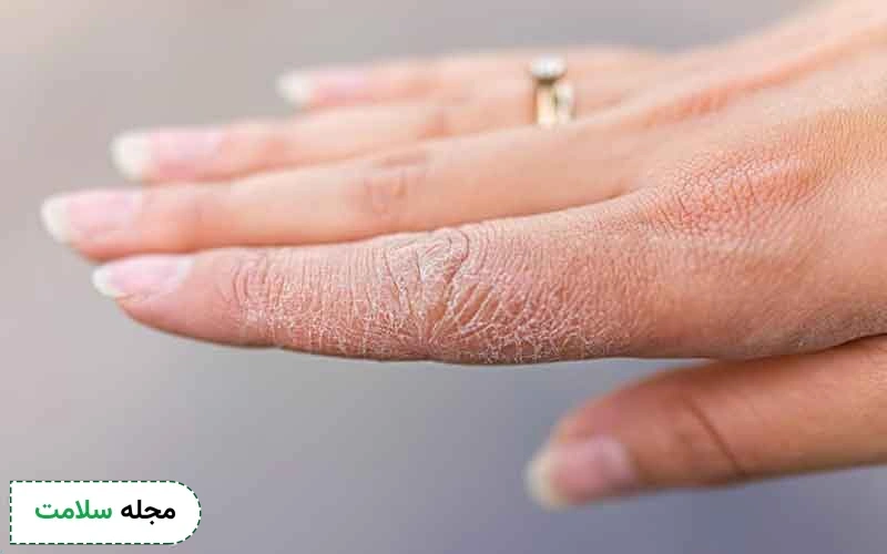 فرق اگزما و قارچ چیست؟