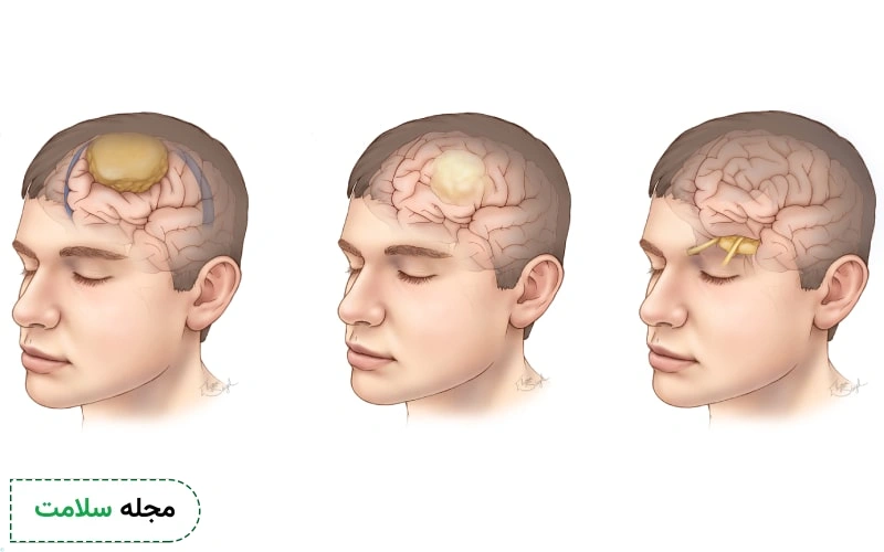 از کجا بفهمیم تومور مغزی داریم؟