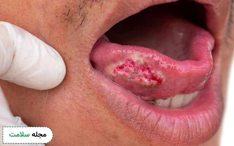 اشکال مختلف سرطان دهان از فک تا زبان