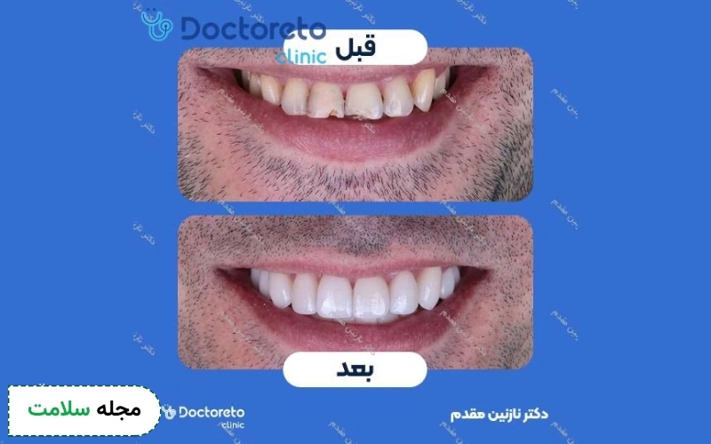 عکس کامپوزیت دندان مردانه قبل و بعد