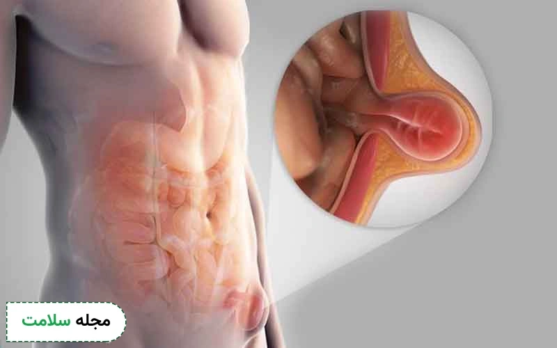 فتق بیضه چیست؟ بررسی علائم و روش های درمانی و پیشگیری