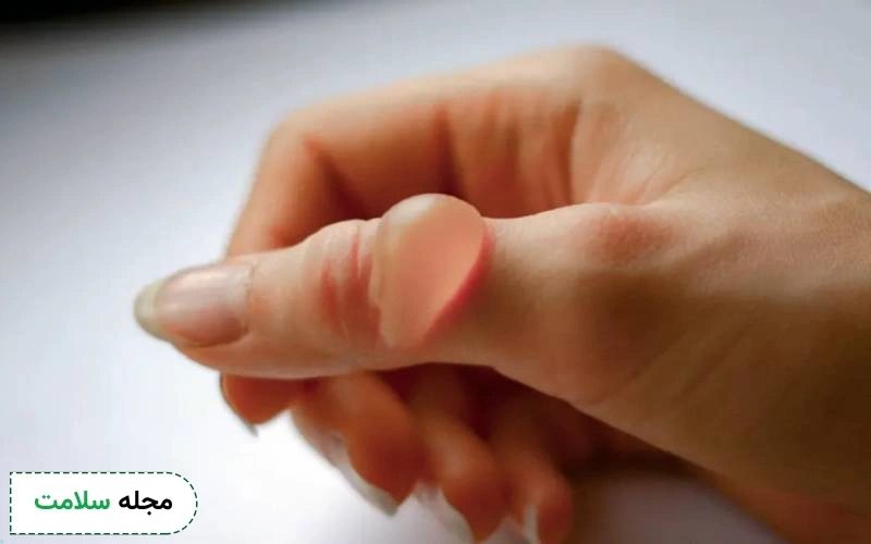 دلیل تاول زدن ناگهانی دست چیست؟