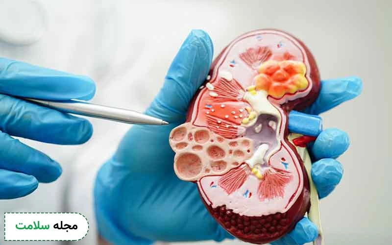 دیابت و بیماری های کلیوی چه ارتباطی با یکدیگر دارند؟