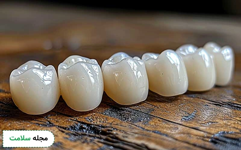 قالب گیری دندان برای روکش چگونه انجام می شود؟
