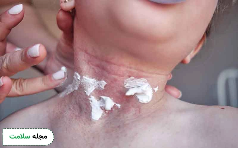 دیابت و بیماری پوستی چه ارتباطی با هم دارند؟