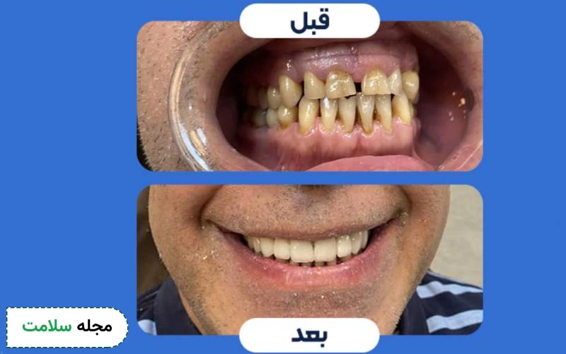 عکس کامپوزیت دندان فاصله دار قبل و بعد
