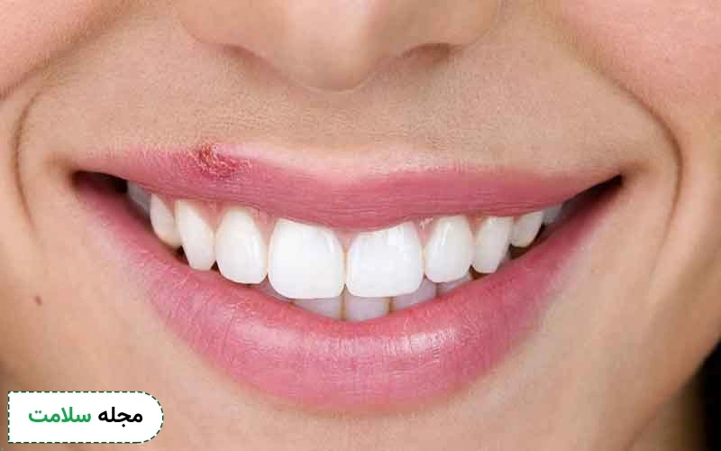 تصویر تب خال لب چگونه است؟