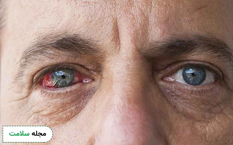 دیابت و بیماری های چشم؛ آیا دیابت باعث بیماری‌ های چشمی می‌ شود؟