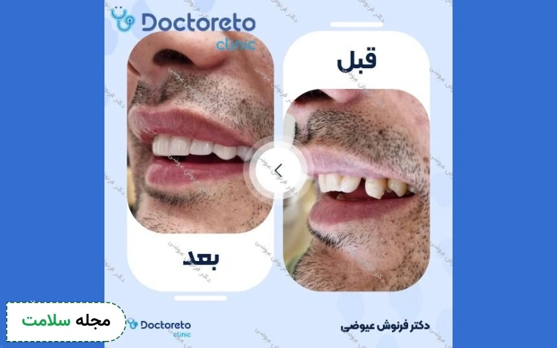 عکس کامپوزیت دندان کج