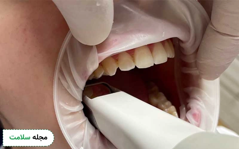 قالب‌گیری دندان برای روکش به روش دیجیتال چگونه است؟