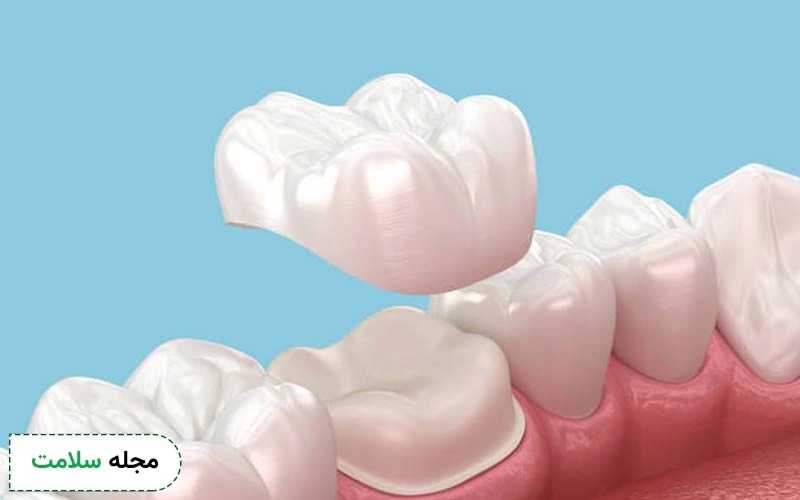 عکس تراش دندان برای روکش چگونه است؟
