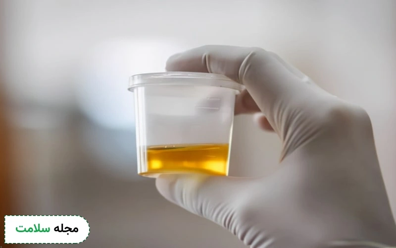اصلاح سبک زندگی برای کاهش سریع دفع پروتئین از کلیه موثر است.