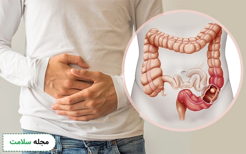 شکل مدفوع در سرطان روده چگونه است؟