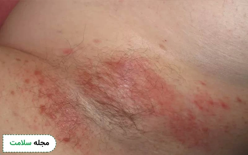 عکس عرق سوز شدن زیر بغل چگونه است؟