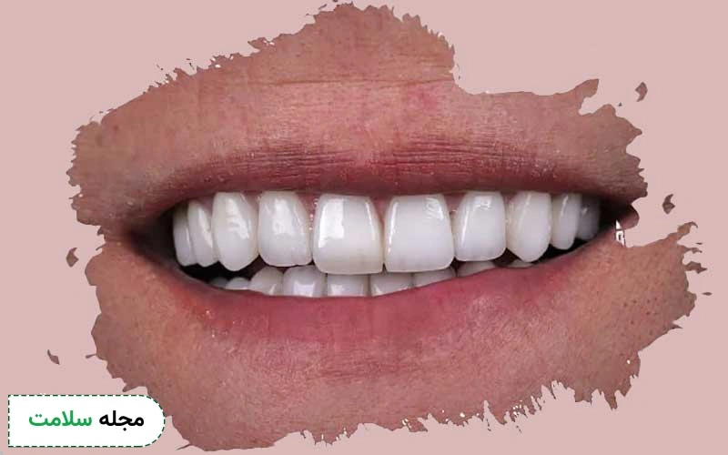 عوارض قالب گیری دندان برای روکش چیست؟