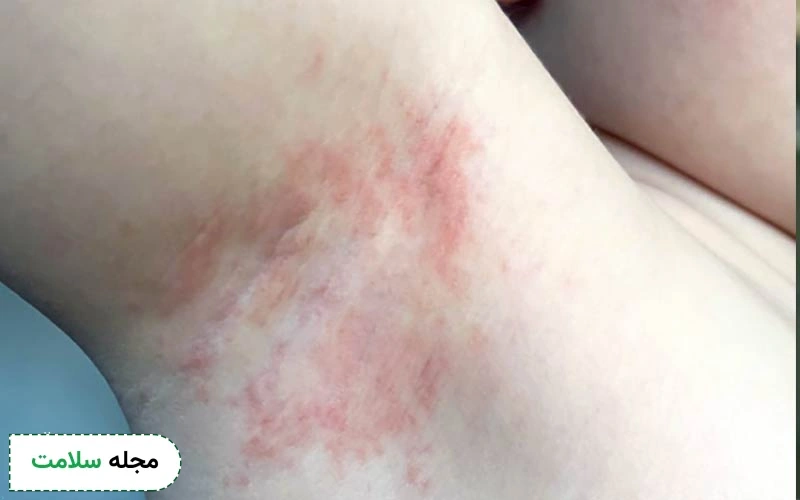 عرق سوز شدن زیر بغل چه علائمی چیست و چگونه رفع می شود؟