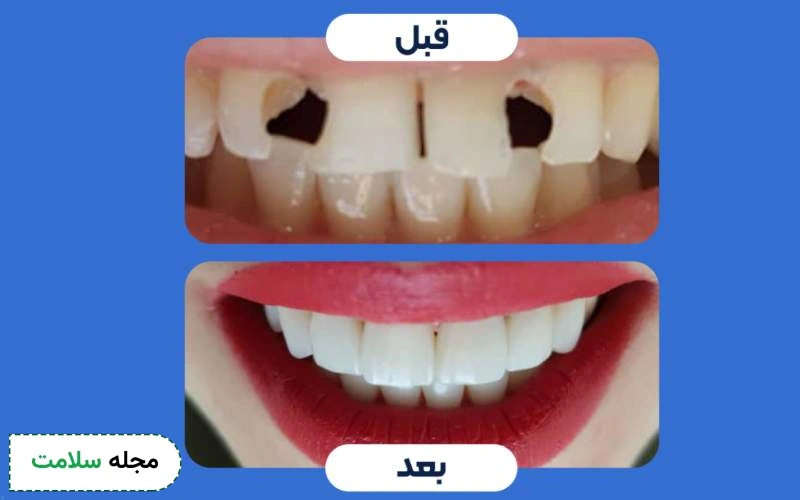 عکس قبل و بعد کامپوزیت دندان ترک خورده و شکسته چگونه است؟