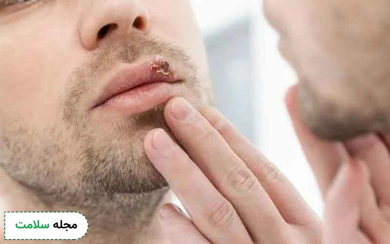 چگونه در کمترین زمان ممکن تب خال لب را مهار کنیم؟