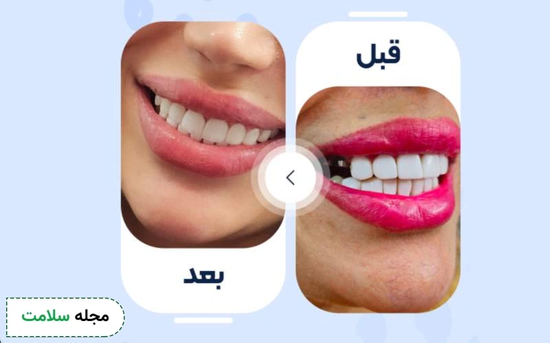 عکس قبل و بعد کامپوزیت دندان خلفی چگونه است؟