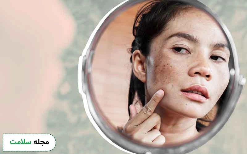رفع لک صورت با چه روش هایی امکانپذیر است؟