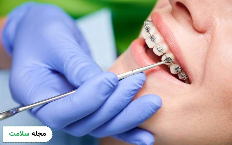 مراحل ارتودنسی بزرگسالان چگونه است؟