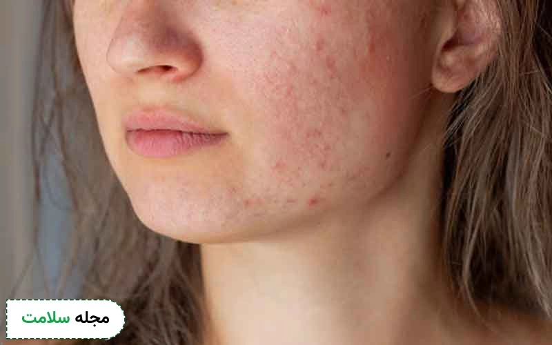 مصرف برخی داروها دلیل بروز لک صورت است؟