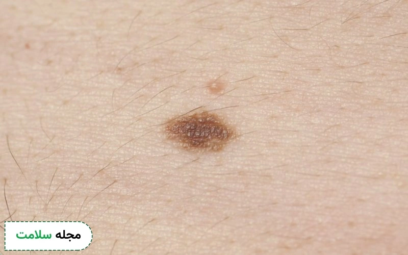 ملانوما چیست؟