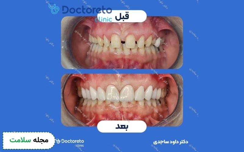 عکس دندان تراش خورده برای کامپوزیت