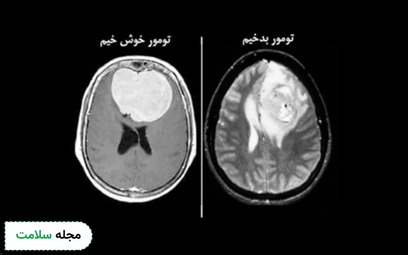عکس تومور مغزی بدخیم بدین شکل است.