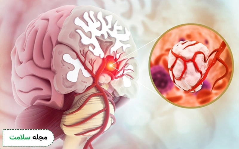 پیشگیری از تومور مغزی چگونه است؟