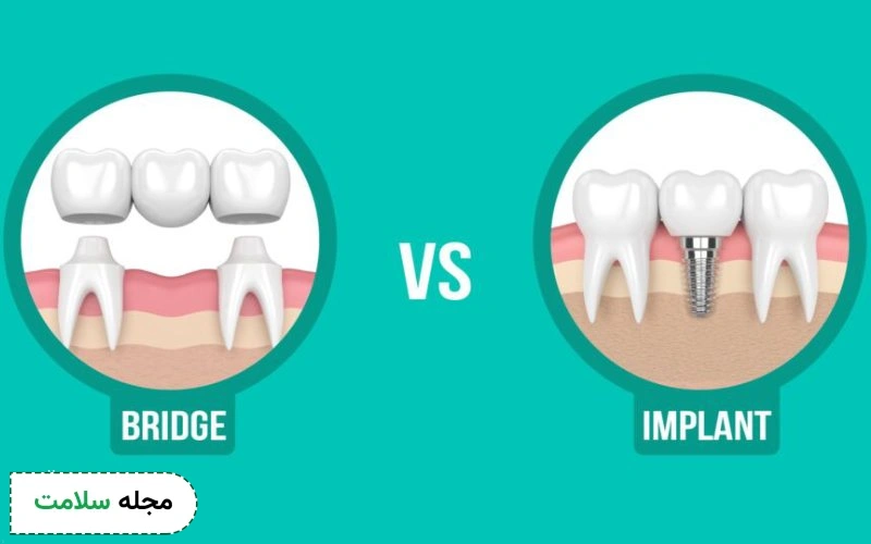 تفاوت پل دندان با ایمپلنت چیست؟