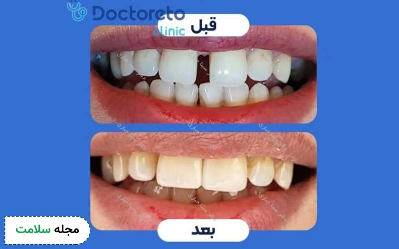 عکس کامپوزیت دندان جلو قبل و بعد