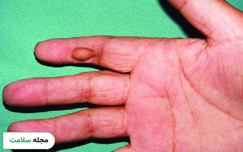 عکس زخم تاول دست دیابتی