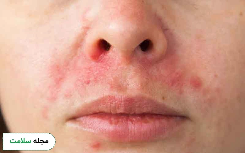 اگزما صورت چیست؟