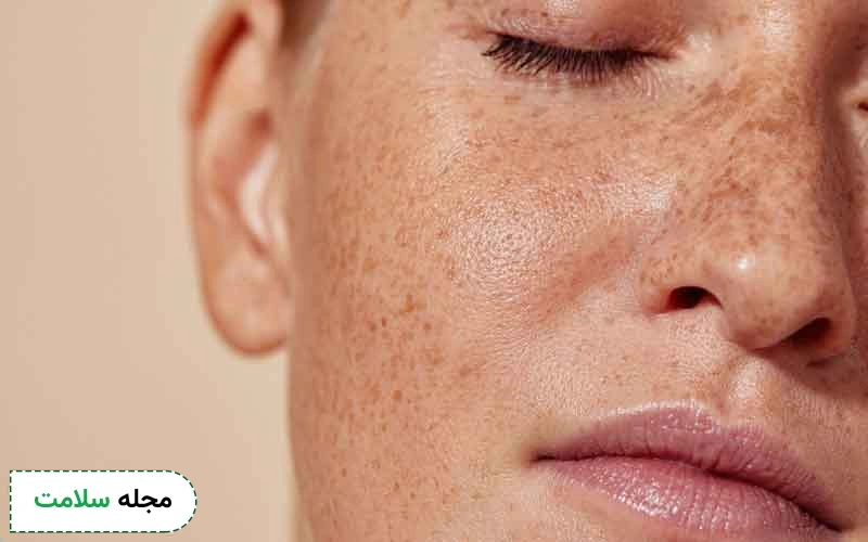 روش های رفع لک صورت چیست؟