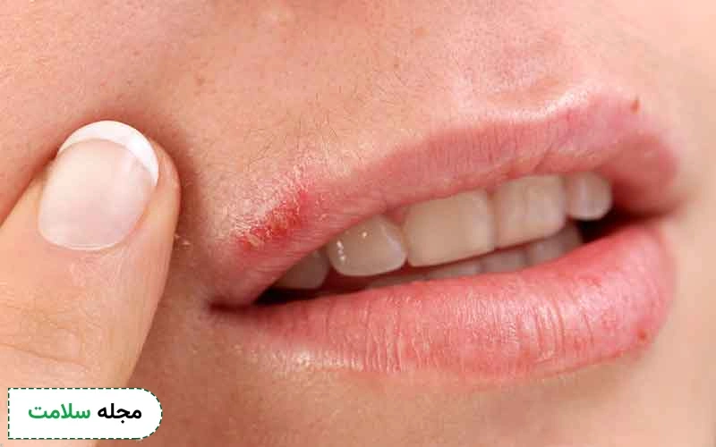 رعایت بهداشت برای درمان تبخال لب ضروری است.