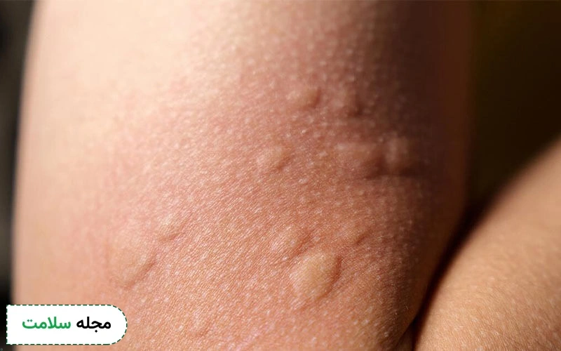 کهیر بارداری: علل، علائم و تجربیات زنان باردار از کهیر پوستی